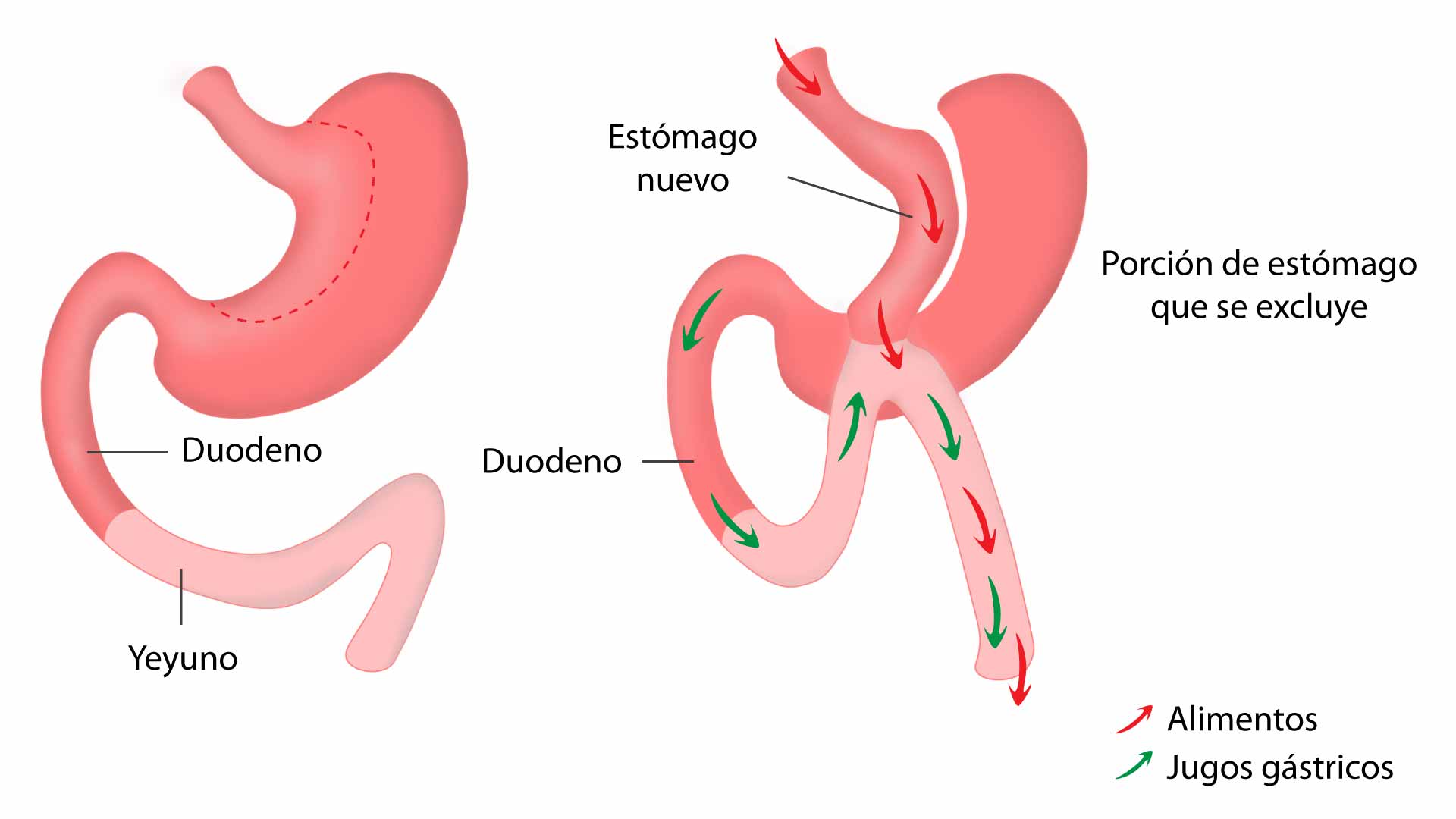 Mini Bypass G strico DR EDUARDO SILVA B Tratamientos Obesidad Mini Bypass G strico DR EDUARDO SILVA B Tratamientos Obesidad